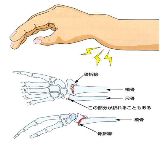 手首の骨折
